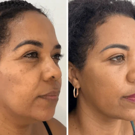 Collagen Fit™ - Maska za pomlađivanje kolagena